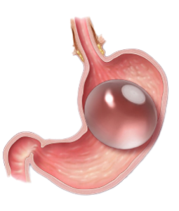 Gastric Balloon (1)
