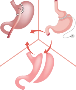 Revisional bariatric surgery (1)